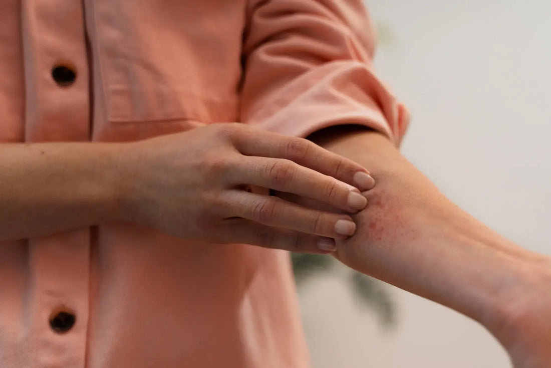 Kako ublažiti akutne izbruhe atopičnega dermatitisa z visoko koncentracijo kalamina