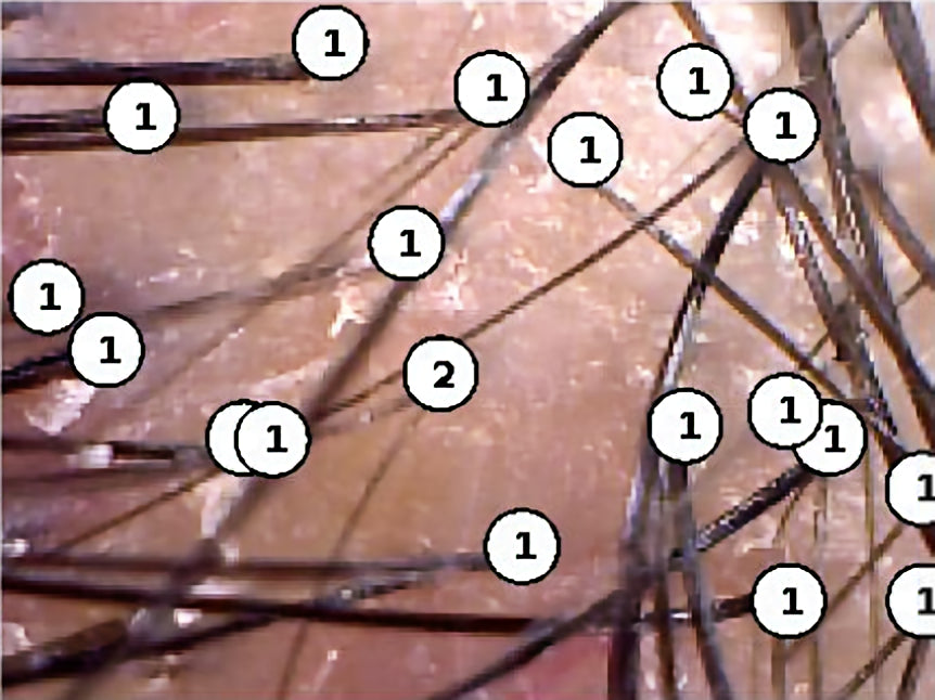 Microcamera image of the scalp at the start